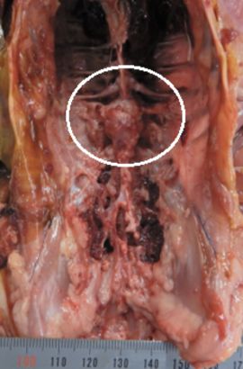 Enterococcus cecorum